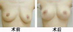 <b>矫正乳房下垂手术</b>