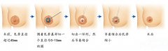 <b>乳头乳晕缩小术</b>