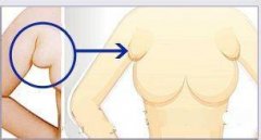 <b>副乳手术介绍</b>