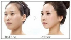 <b>磨颧骨多少钱</b>