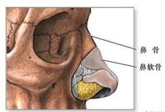 驼峰鼻整形术