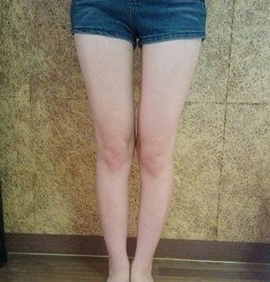 做了大腿吸脂，和大家一起分享术后果