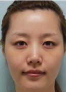 JMS 我做了眼睛+颧骨下颌角+脂肪填充(*^__^*) 嘻嘻
