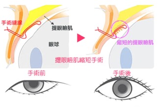 关于上睑下垂