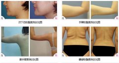 <b>吸脂案例对比图</b>