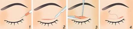 图解3种不同的双眼皮手术方式