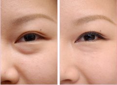 <b>祛眼袋术内切和外切哪个果好</b>