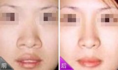 <b>鼻翼缩小介绍</b>