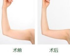<b>手臂吸脂有什么特点和优势？</b>