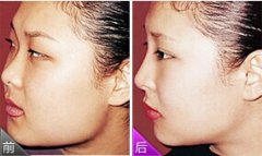 <b>肿眼泡吸脂</b>