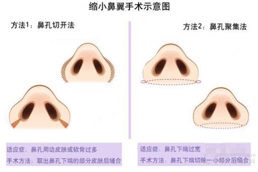 鼻翼缩小手术原则及适应症