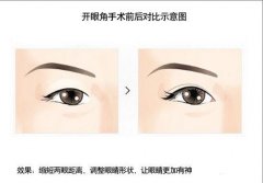 <b>四种方法开眼角前后对比图</b>