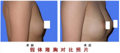 <b>自体脂肪移植丰胸怎么样？</b>