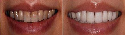 四环素牙齿应该怎样美白呢?