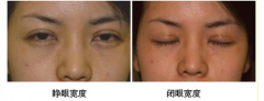 双眼皮手术问题之眼皮的宽窄：