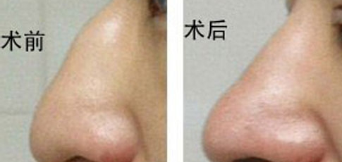 驼峰鼻整形的手术方法？