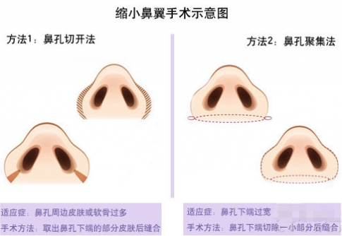 什么是鼻翼缩小术？术后注意事项