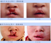 <b>兔唇的较佳调节时间是何时?</b>