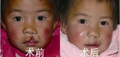 <b>国内做唇腭裂修复手术没问题吗?</b>