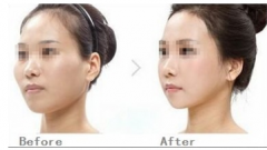 <b>国内做磨颧骨整形术没问题吗?</b>