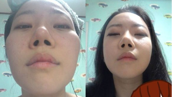成都做颧骨整形术后的恢复期需要多久?