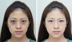 <b>彩光嫩肤去黑眼圈后有哪些注意事项?</b>