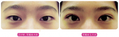 <b>双眼皮失败修复术没问题吗?</b>
