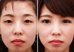 <b>做双眼皮修复术有哪些注意事项?</b>
