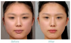 <b>注射注射瘦脸瘦脸没问题吗?</b>