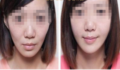 <b>常见的丰脸手术方法有哪些?</b>