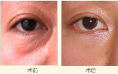 <b>自体脂肪填充眼睑凹陷果怎么样?</b>