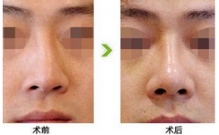 <b>鼻子歪了还能矫正吗?</b>