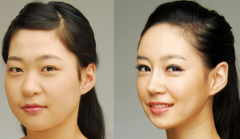 <b>成都面部吸脂能改脸型吗?</b>