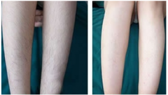 <b>冰点脱毛的果怎么样?</b>