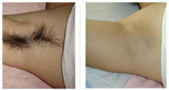 <b>通过冰点脱毛有什么特点?</b>