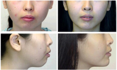 <b>常见的垫下巴材料都有哪些?</b>