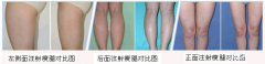 <b>注射注射瘦腿瘦腿的果怎么样?</b>