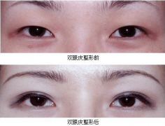 <b>双眼皮修复术什么时候做较好?</b>