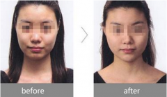 <b>玻尿酸丰面颊的果怎么样?</b>