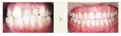 常见的矫正牙齿的方法有哪些?