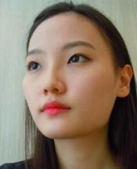 点击进入连续看图模式 方下巴手术和面部轮廓术看看我手术前后的模样