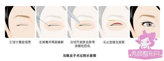 双眼皮手术过程图详解