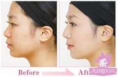 上海哪家医院做隆鼻修复较好