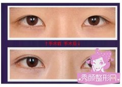 眼部整形价格表一览