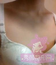 做了【自体脂肪隆胸】你们看自然不?
