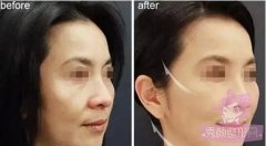 <b>热玛吉和超声提拉哪个除皱果好？紧致肌肤好？</b>