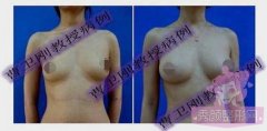 <b>上海九院曹卫刚隆胸怎么样|术前术后案例对比</b>