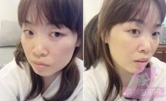 分享双眼皮+隆鼻+自体脂肪垫下巴+注射瘦脸3个月的