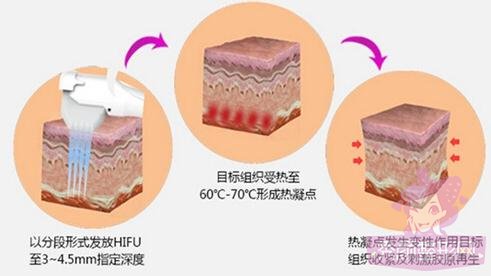 北京八大处做超声提拉除皱怎么样?多少钱?