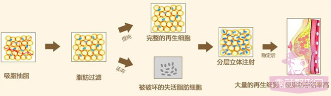 北京东方和谐张准自体脂肪隆胸怎么样？案例图